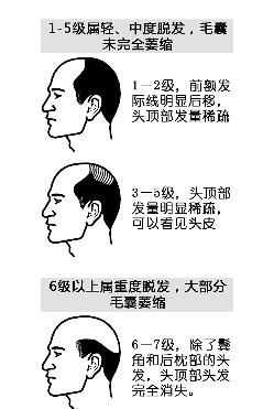 杭城男子脱发后用避孕药抹头致斑秃加重(图)