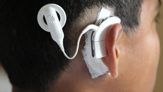 耳蜗设备在中国的竞争致使其在政府和病人的价